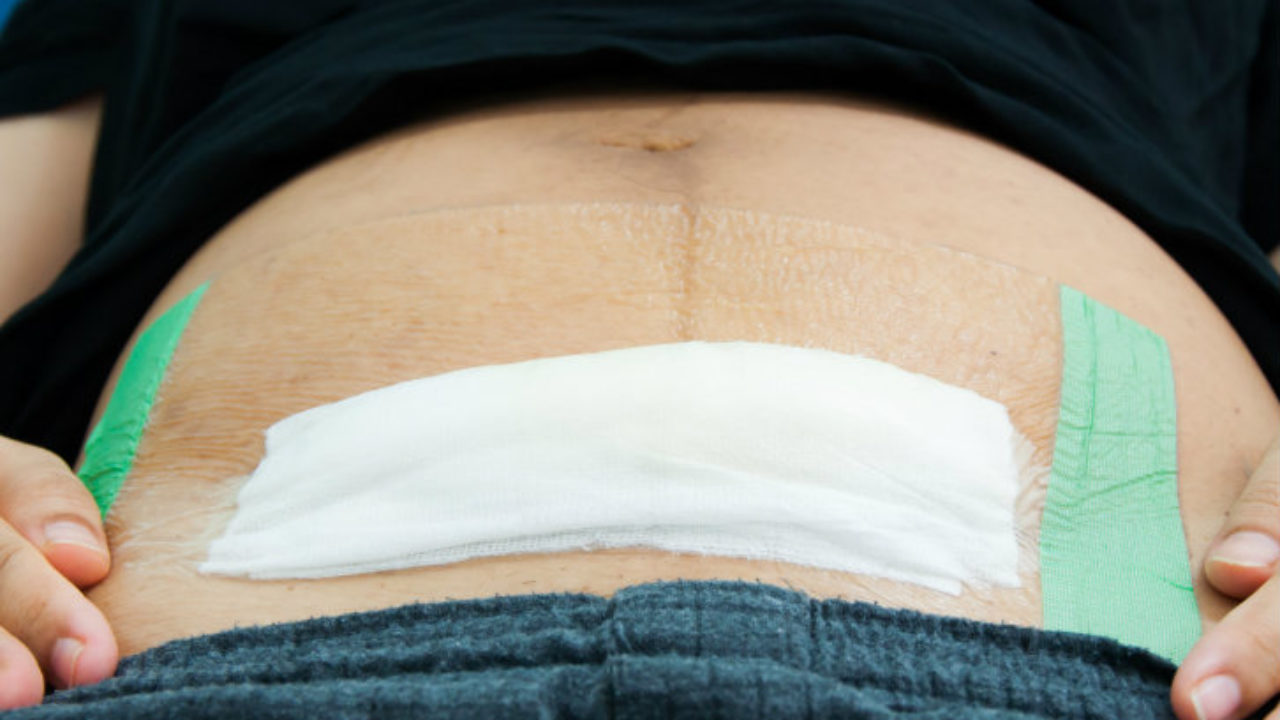 After Your Tummy Tuck: A Guide